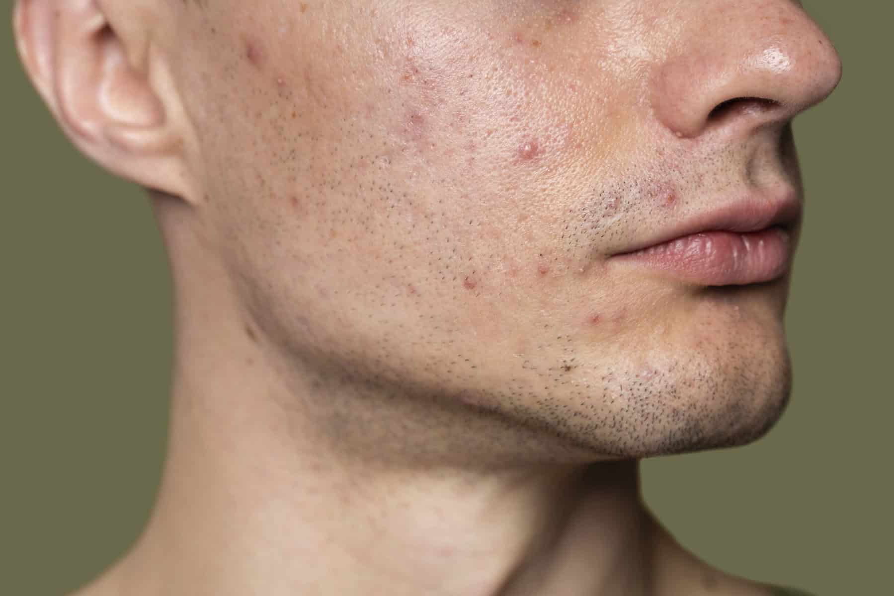 confident-handsome-man-with-acne